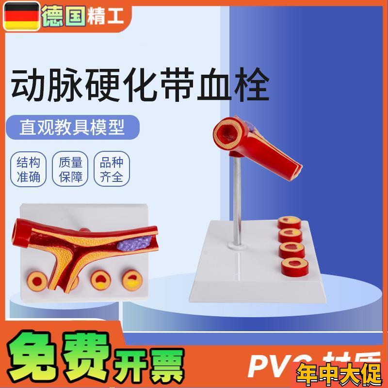 德国】动脉带血栓模型 r5部件  血管堵4塞 血管粥样血管病理解剖