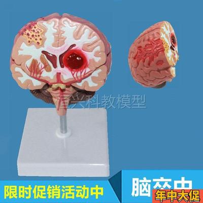 脑卒中模型大脑血管分布脑室皮层功能延髓脑干小T脑神经外科病理