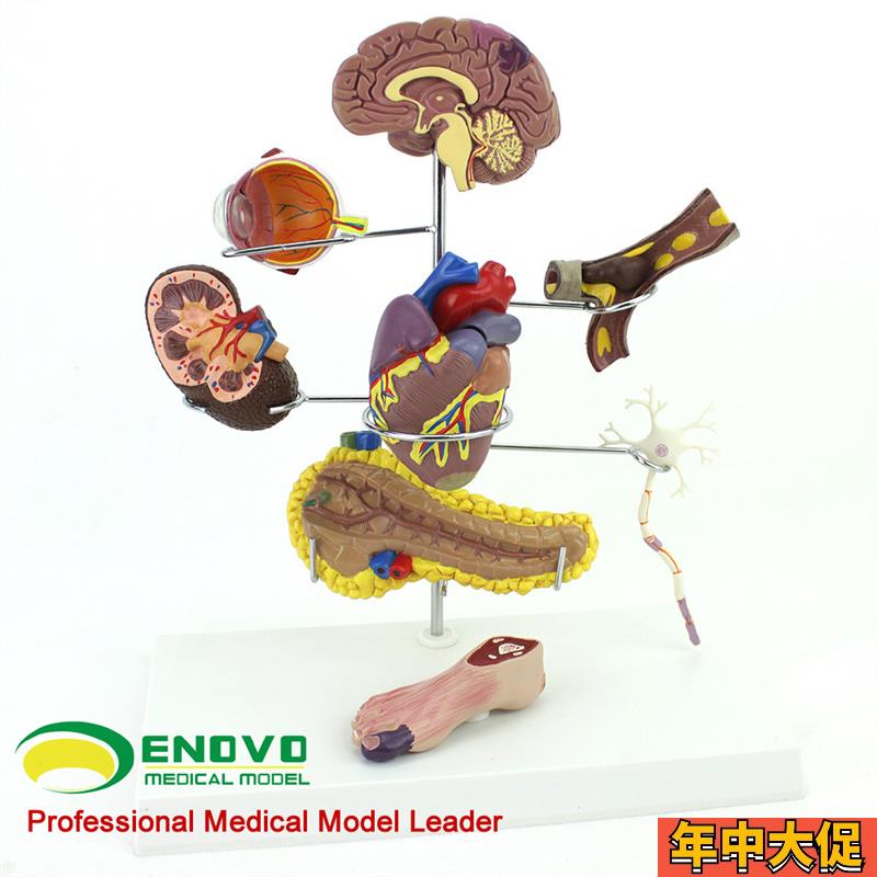 ENOVO颐诺人体医学糖尿病模型 糖尿G病并发症大脑心脏胰腺神经元