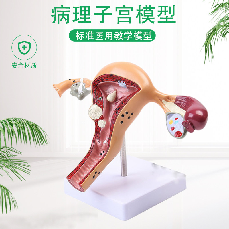 女病理子宫模型 女妇产子t宫结构解剖 高级仿真病态子宫模型包邮