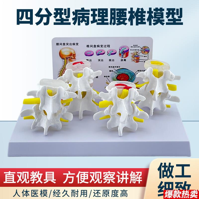 四分型病变E腰椎与正常腰椎组合模型人体骨骼病理骨骼模型