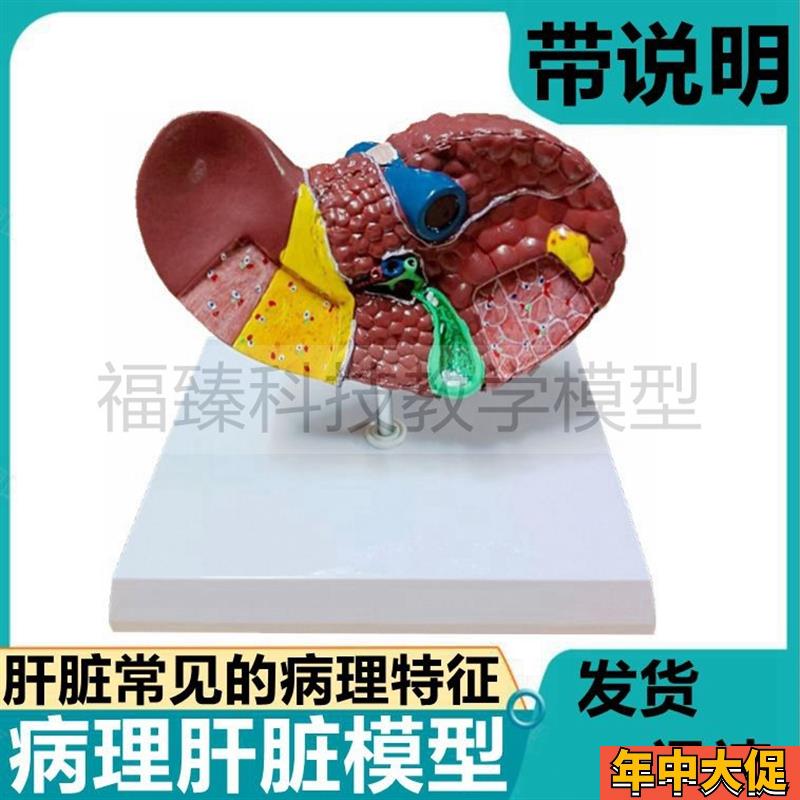 病理肝脏模型g 炎硬脂肪医患沟通酒精人体胆管血管分布胆囊门静脉