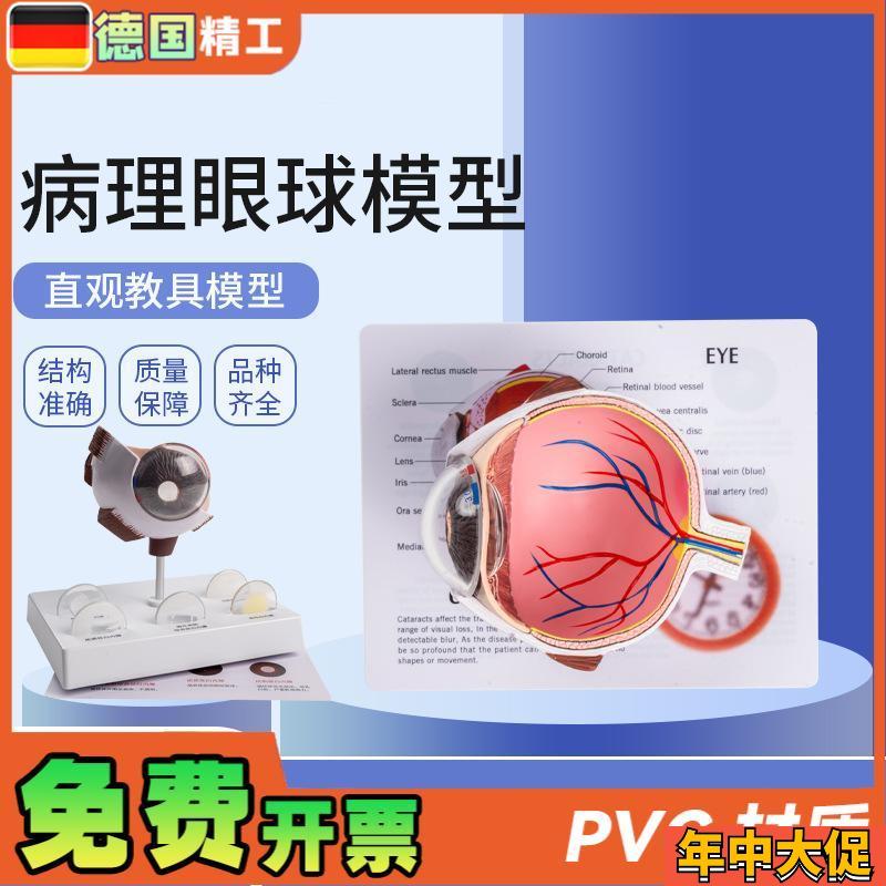 德国】病理眼球模型 眼球模型 角膜病变眼球模型T 医学教学教材模