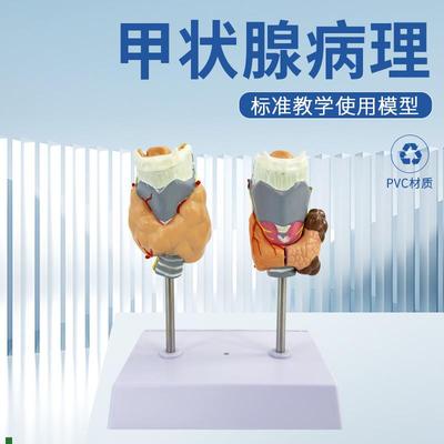 病理甲状腺模型喉头解剖模型甲状J腺留甲状线囊中甲状线病