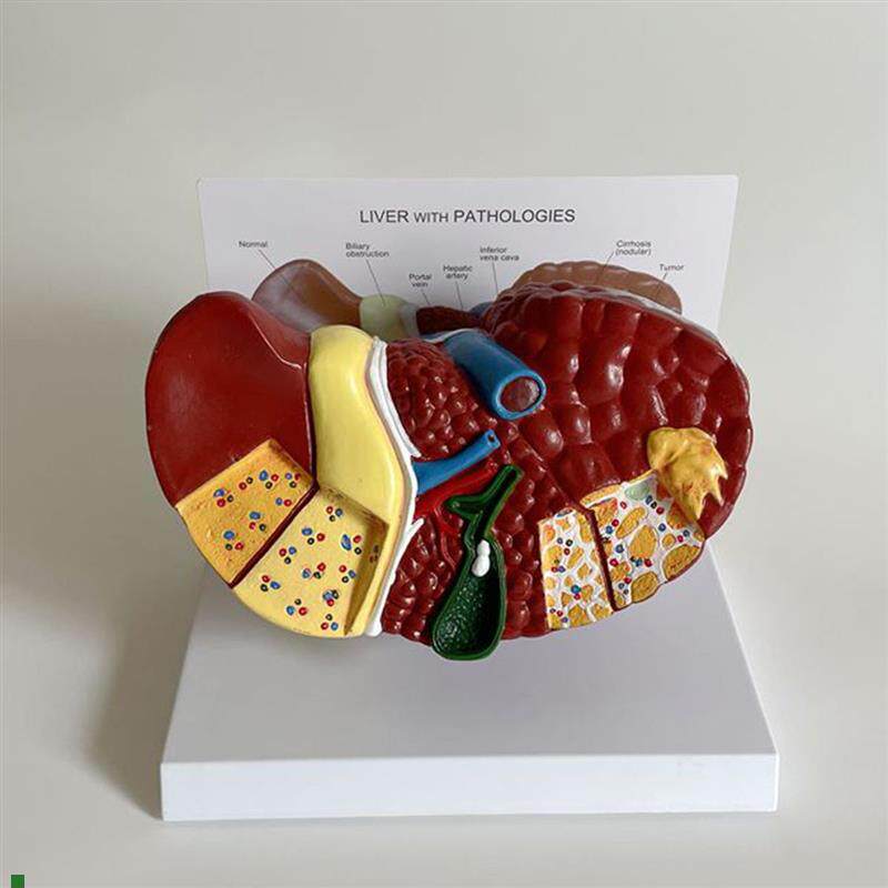 病理肝脏模型胆囊肝门静脉脂肪酒精D炎肝脏医药促销医患胆总管肝