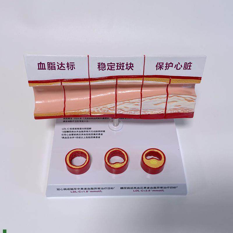 病理心血管模型粥样硬化脂肪斑块动脉内膜M受损程度医药促销礼品