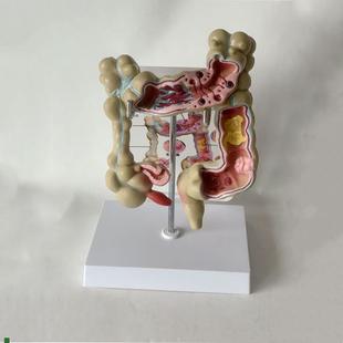 病理结肠模型盲肠阑尾肠扭转梗阻消化道J外科医药促销穿孔病变大