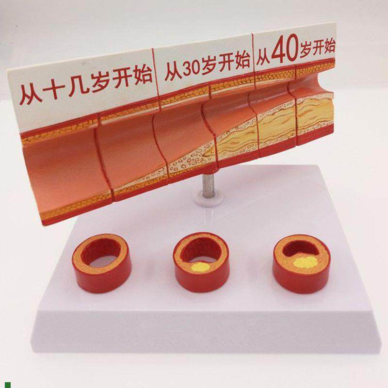 动脉血管a模型不同年龄段血管内膜变化粥样硬化栓子血管狭窄斑块