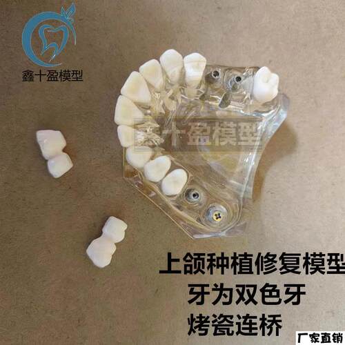 牙科种植模型2011上颌种植解说义齿修复烤v瓷连桥种植钉模型