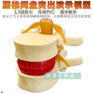 脊柱模型脊d椎骨头腰椎间盘模具椎体模型突出受压病理骨质教具包
