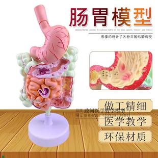 人体病理肠胃模型消化道胃冠状剖面横结肠R内科肠胃解剖模型