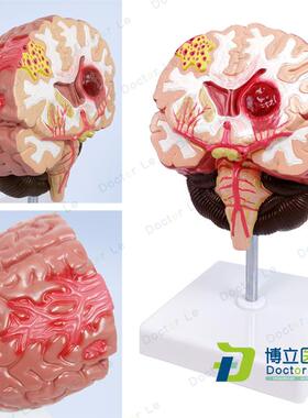 人体脑解剖脑病理疾p病脑病理构造脑(血管)病变脑模型