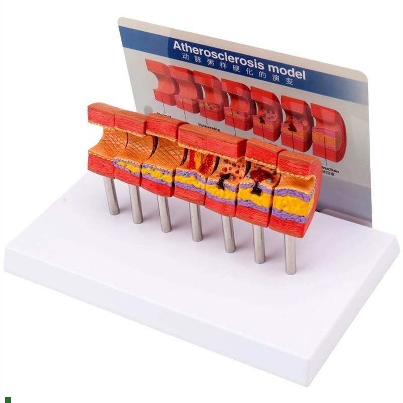 心脑血管a堵塞动支脉粥样硬化血栓血液浓度脂肪病理教学用模型道