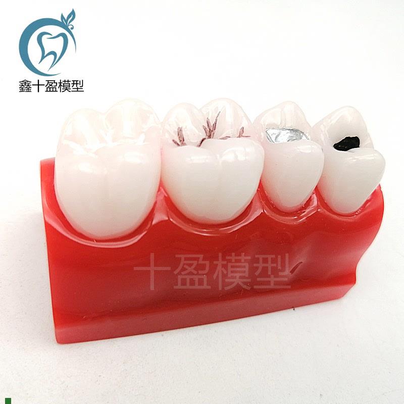 牙科口腔窝沟封闭展示医t患教学模型儿童防蛀龋坏牙齿模型M10