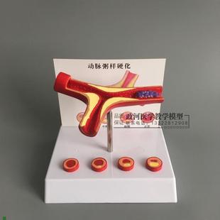 冠状动脉性心h血管动脉硬化模型老年心脏模型血栓形成