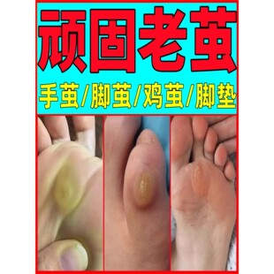 【新人专享价】鸡茧清去脚底脚掌老茧软化剂脚茧死皮厚茧硬皮脚趾