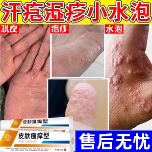 【新人专享价】汗泡疱疹药膏汗孢疹汉状手痒珍手上起小水泡汗状疱