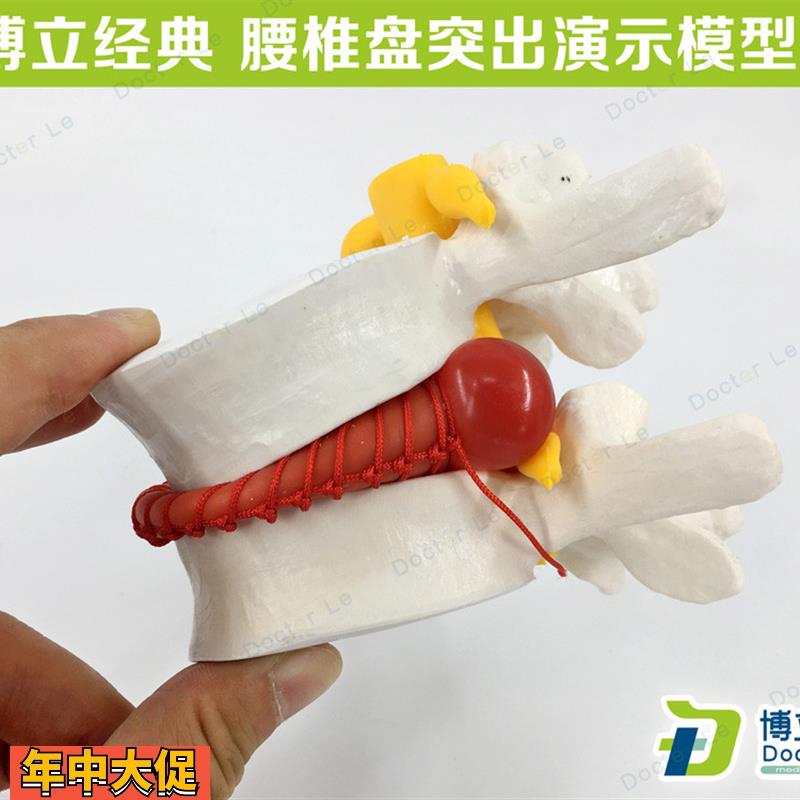 腰椎放大腰椎间盘突演示模型人体脊柱脊椎骨病理演示