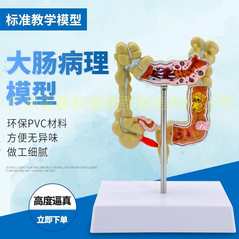 大肠病理模型大肠模型肠胃病变解剖模型肠道疾病人体结肠病变模型