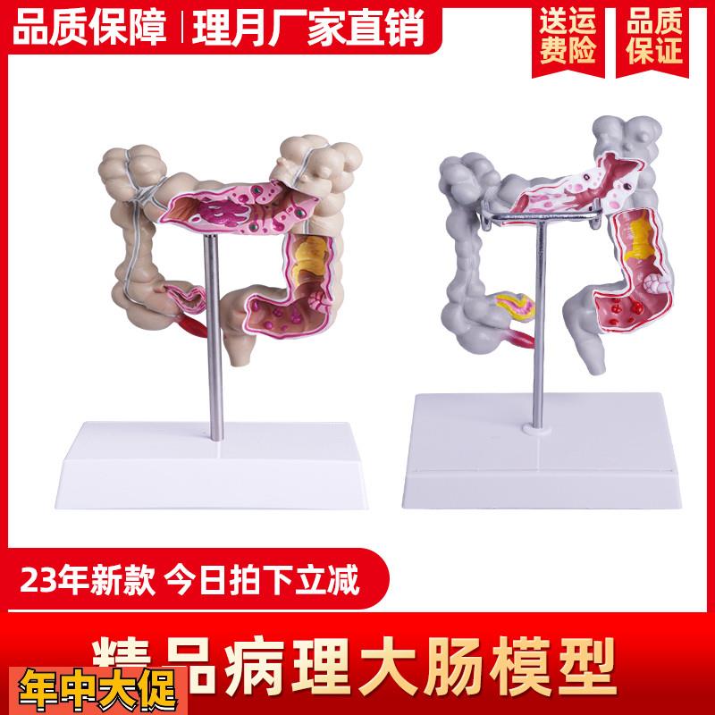 人体结肠病变模型大肠病理模型大肠模型肠胃病变肠道疾病解剖模型