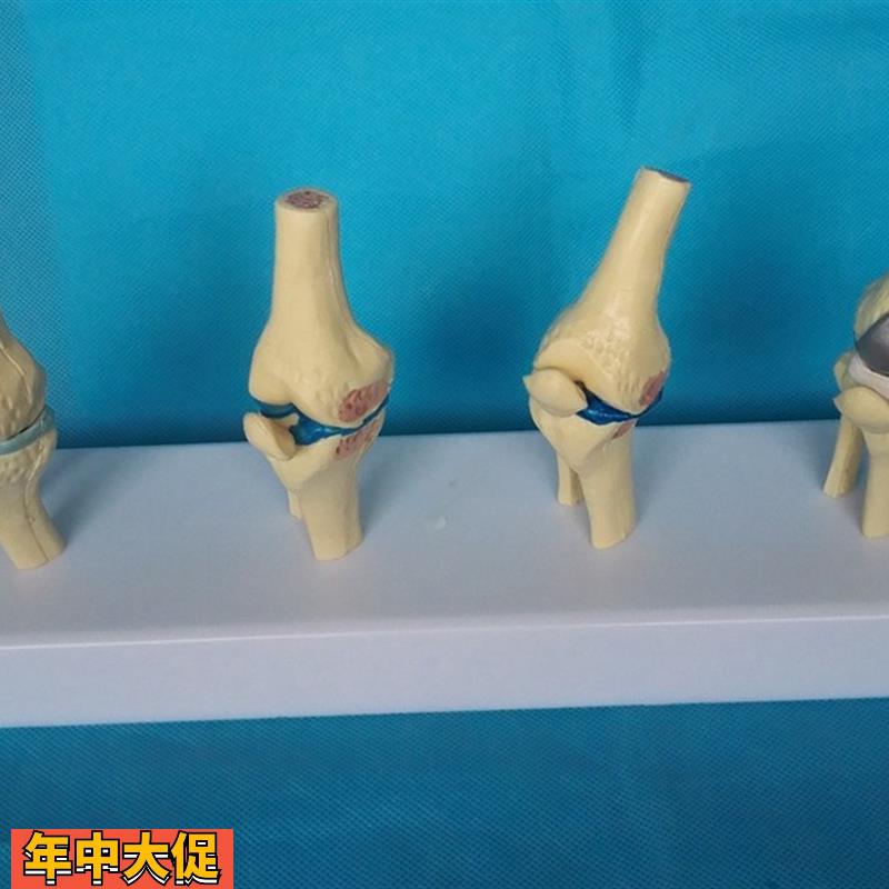 病变膝关节比较模型骨骼骨架模型医用人体标本模型
