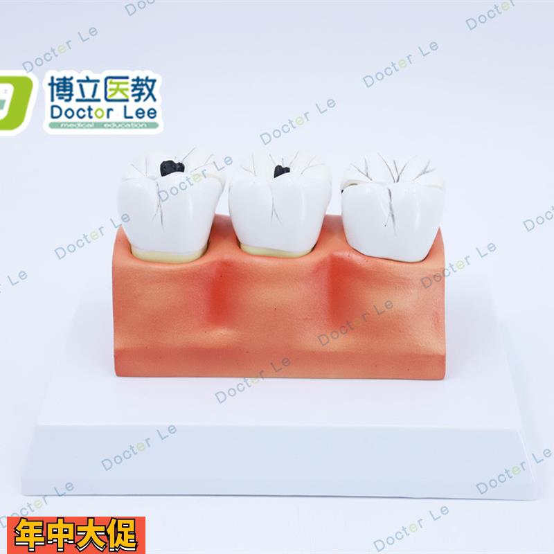 教学仿真龋齿模型牙齿模型病变牙齿模型3颗龋齿模型龋齿分解模型