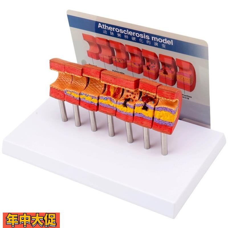 心脑血管堵塞动支脉粥样硬化血栓血液浓度脂肪病理教学用模型道具