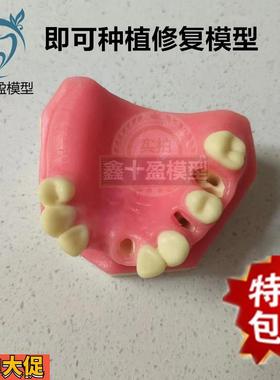 口腔种植练习模型上颌骨上颌窦牙列缺失种植体齿科牙齿模型PIM-21