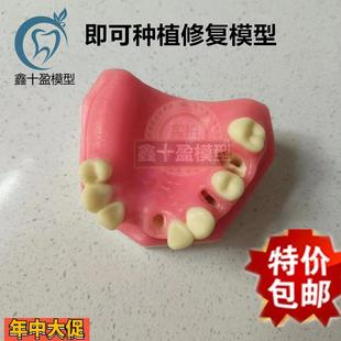口腔种植练习模型上颌骨上颌窦牙列缺失种植体齿科牙齿模型PIM