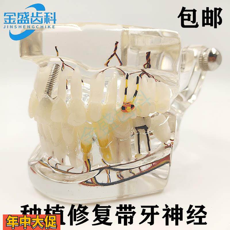 牙科口腔教学模型种植修复体牙模型种植带牙神经模型医患沟通展示