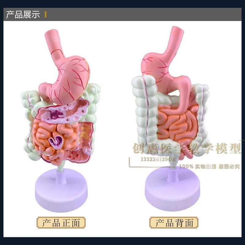 教学结肠病理模型大肠病变标本肠道医患沟通交流人体器官解剖包邮