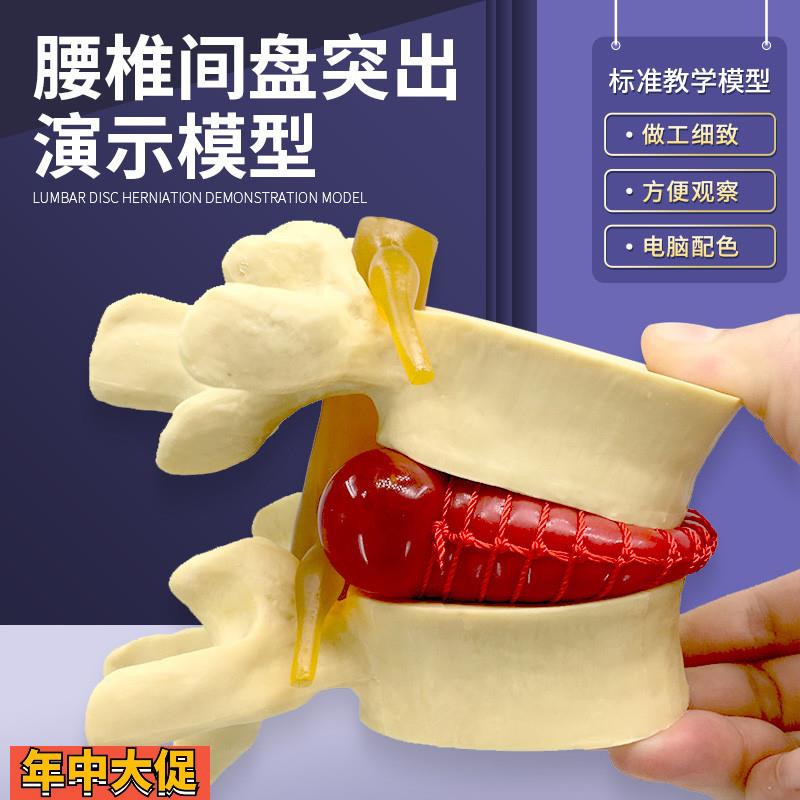 人体脊柱模型脊椎骨头腰椎间盘模具椎体模型突出受压病理骨质教具