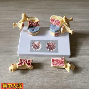 脊椎骨质疏松模型老年人骨骼仿真股骨头密度腰椎变形劳损医患礼品