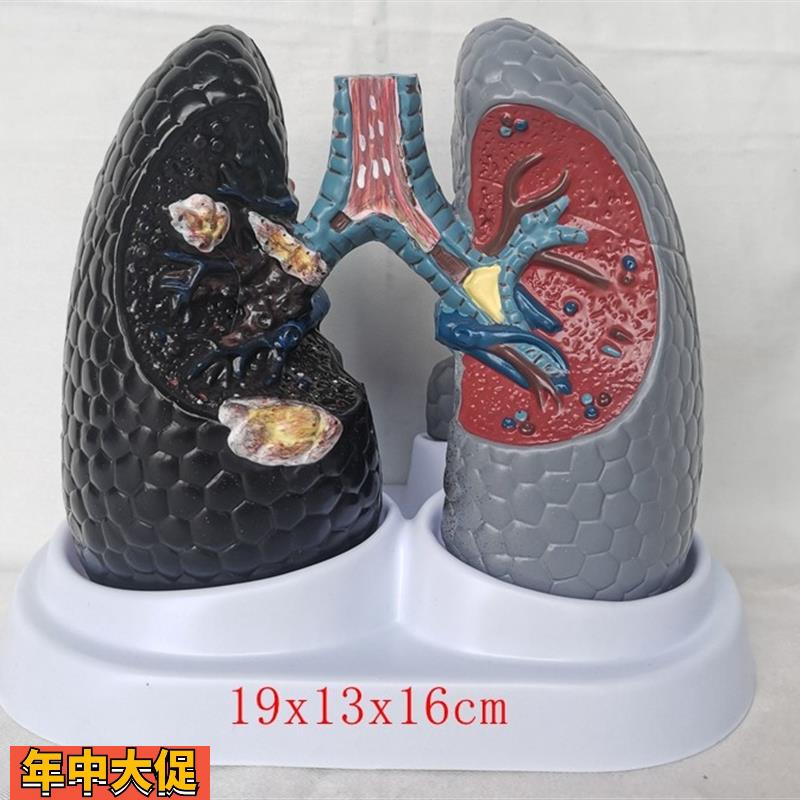 人体吸烟癌变肺模型健康肺模型人类内脏吸烟肺与健康肺模型