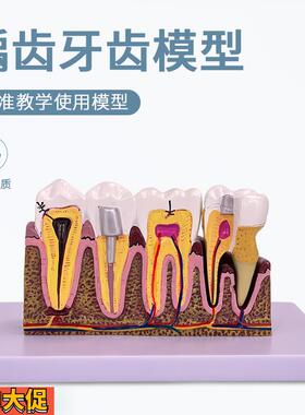 牙科口腔6倍综合病理模型解剖根管及牙神经展示教学模型