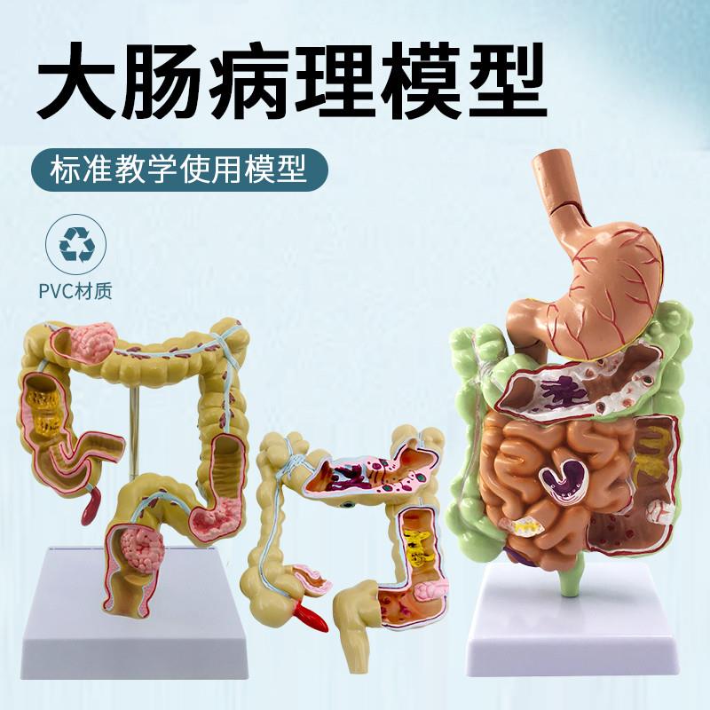 大肠病理模型大肠模型肠胃病变解剖模型肠道疾病人体结肠病变模型