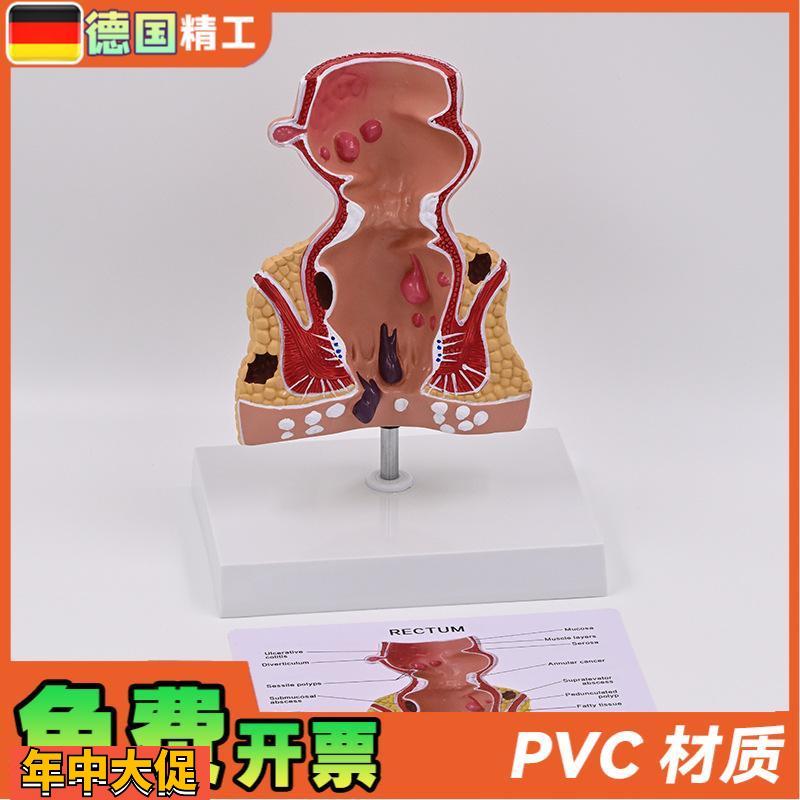 德国】新款大促爆款人体模型肠直肠解剖病理模型病态疾病教具模具