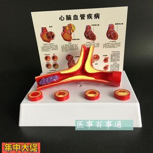 血管模型冠状动脉性心脏病动脉化模型老年科医患沟通演示模型