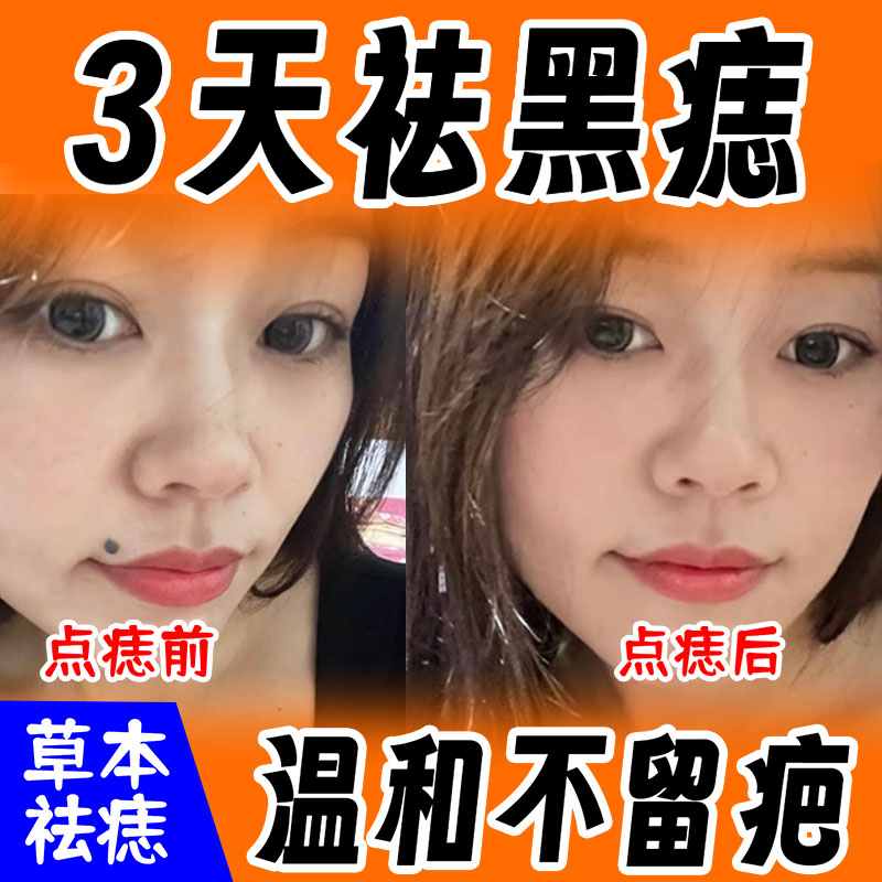祛痣点痣药膏无痕不留疤点痦子药水脸部取黑痣去除美容院正品旗舰