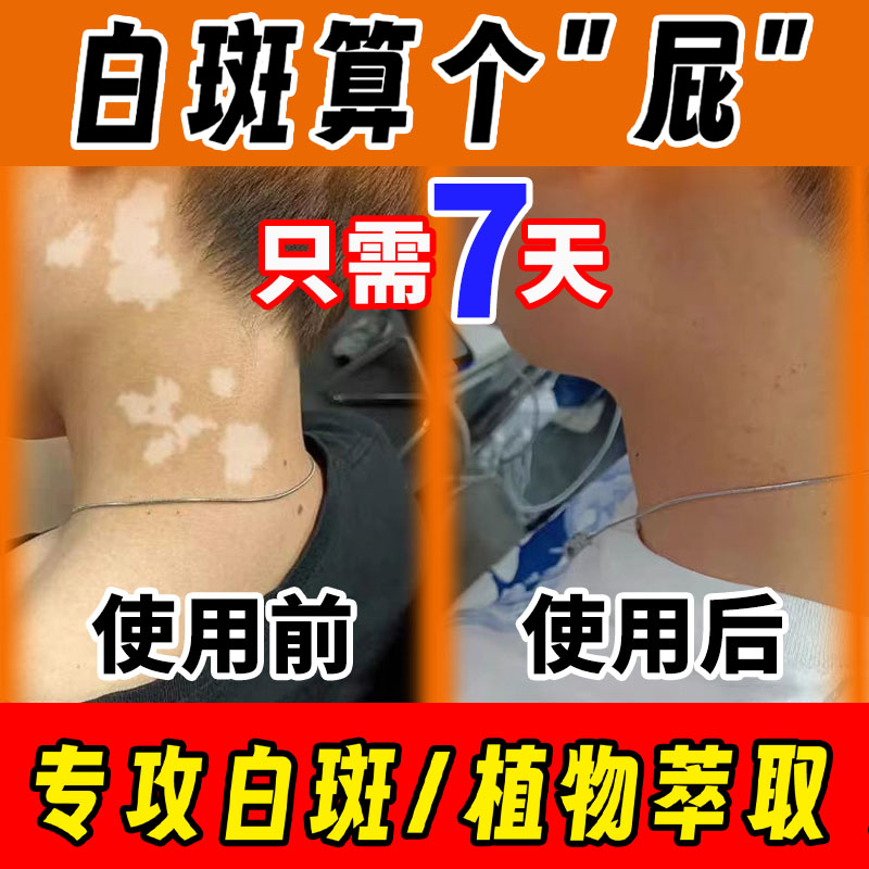 白风癜外用快速消白斑专用补骨脂酊风效特黑色素生长软膏遮盖神器