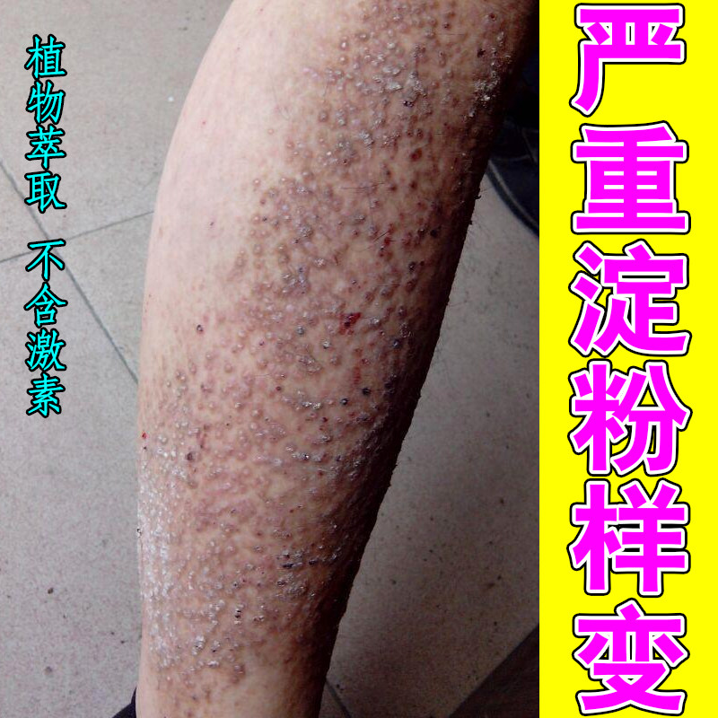 小腿粗糙颗粒褐色蛋白沉积顽固剧烈痒干燥痒黑色素去腿上斑状草本