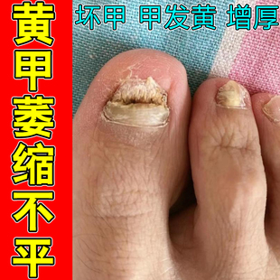 黄甲萎缩不平啃咬指甲受损甲肉分离凹凸不平断裂竖纹修复药草本液