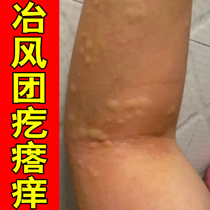 冶风团疙瘩痒掉屑红肿胳膊上长红点痘寒冷性胆碱性换季儿童身上痒