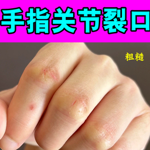 手指关节裂口常年碰水手部皮肤粗糙干皴裂手指爆皮裂口子出血疼痛