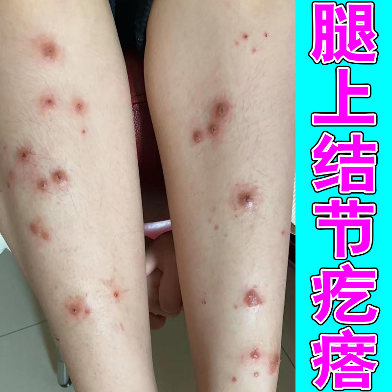 腿上结节疙瘩痒身上掉屑红肿长红斑四肢硬块痘老年人皮肤痒草本膏