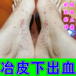 紫点过敏性腿上长红点皮下出血身上有瘀斑瘀点四肢血斑血点专用膏