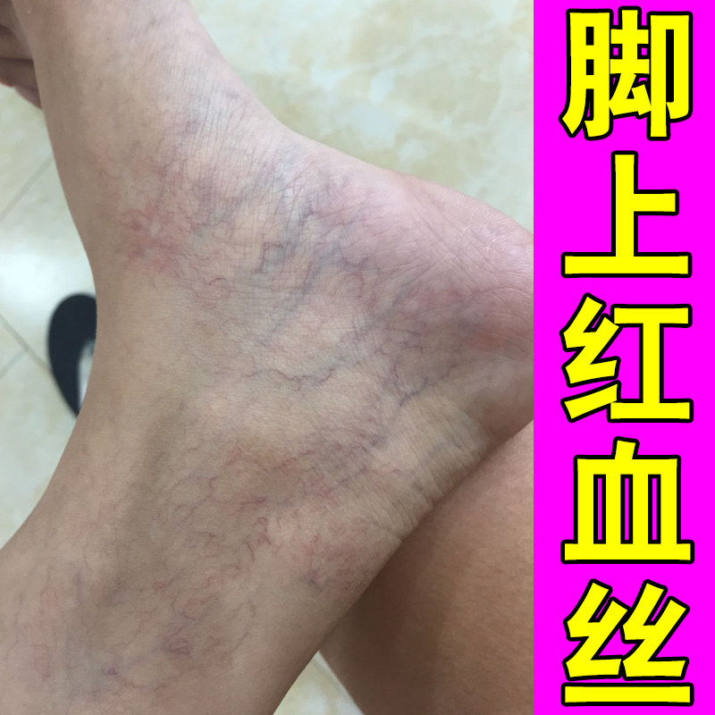 小腿红血丝网状血管显露护理腿部青筋凸起久坐久站下肢沉重外用药