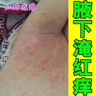 腋下淹红痒宝宝出红痱子腋窝长红斑胳肢窝异味皮肤痒起痘痘疙瘩痒