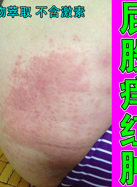 屁股痒红肿大腿内侧痒粗糙干燥起红斑疙瘩感染屁股黑印腿痒红痘痘