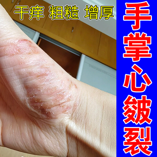 手掌心皴裂角化型粗糙干燥增厚起圆斑红斑手背疙瘩痒修复保湿草本
